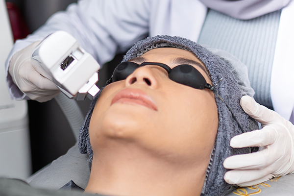IPL Acne